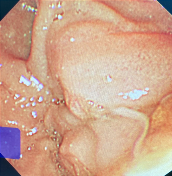 ΢ERCP ü֢תΣΪеҽԺڿ